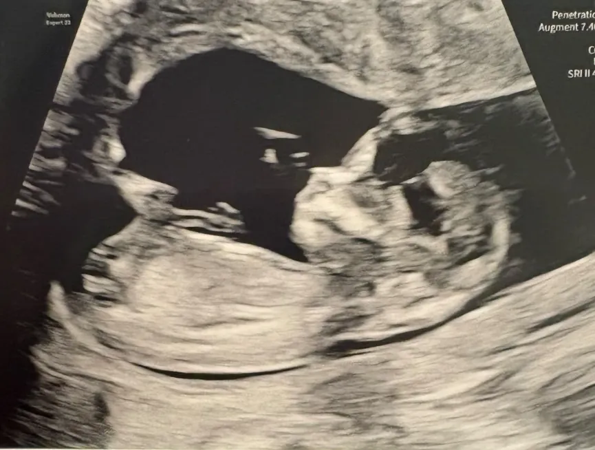 Amy's 20 week scan