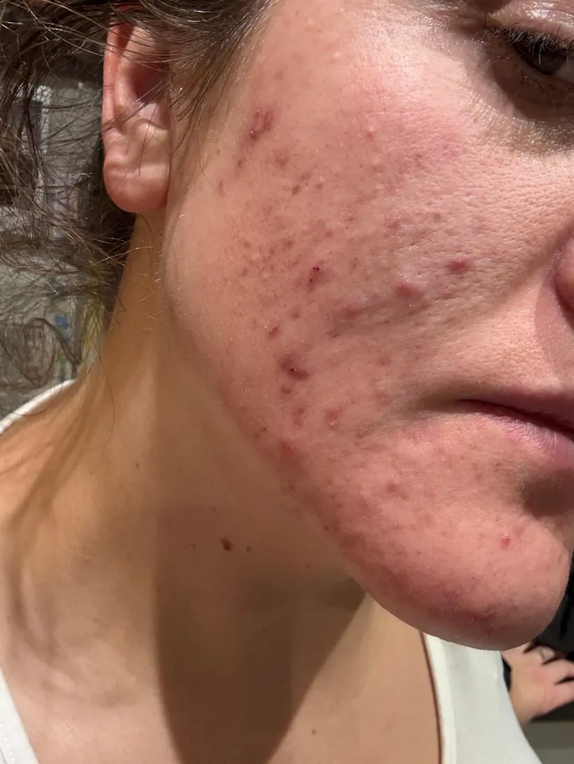 Amy's hormonal acne before coaching