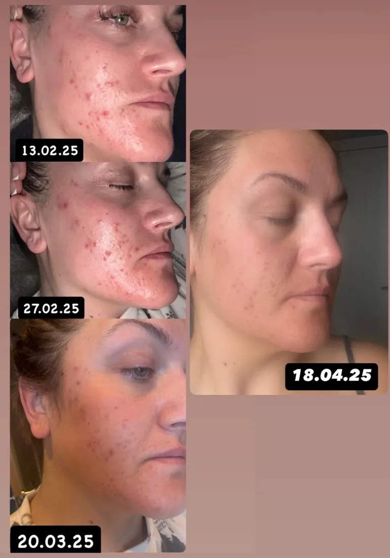 Amy's skin week by week, February to April